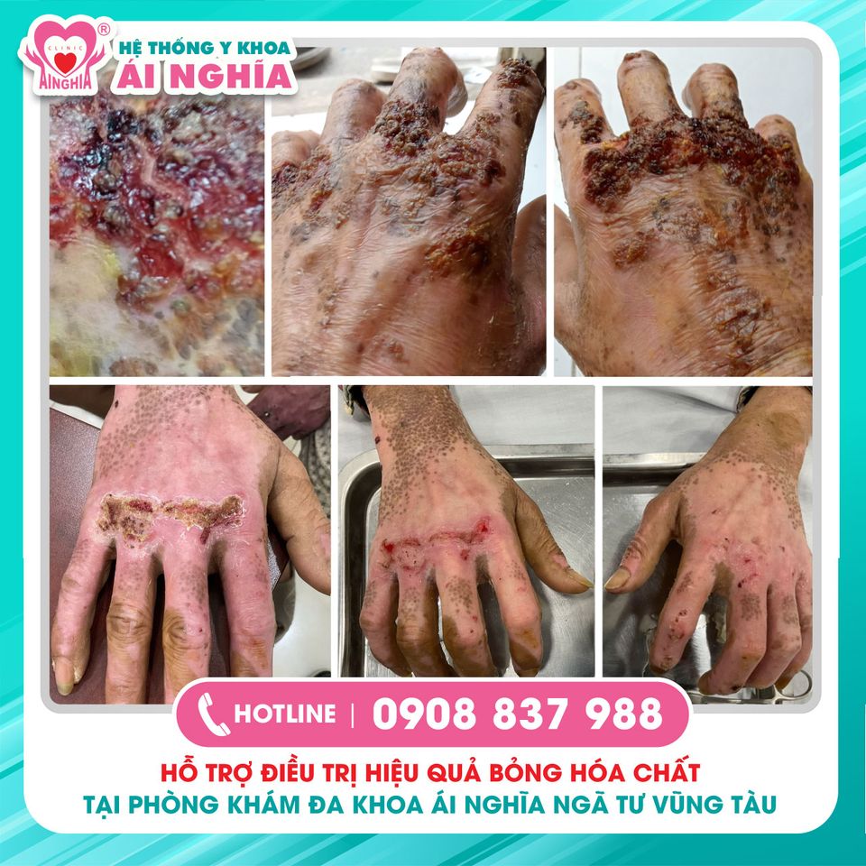 Điều trị hiệu quả bỏng hóa chất biến dạng mu bàn tay