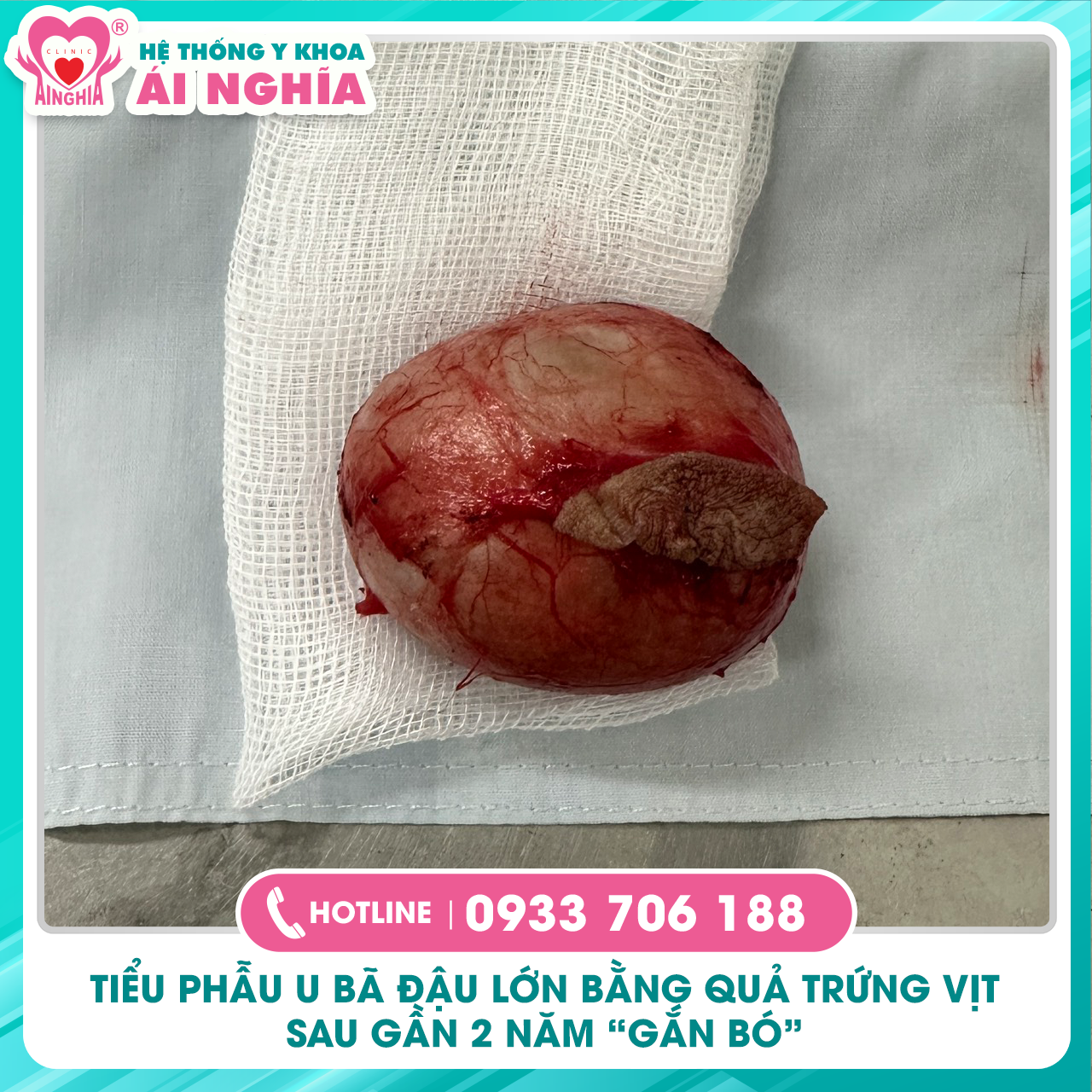 Cắt bỏ U bã đậu kích thước lớn ít gặp