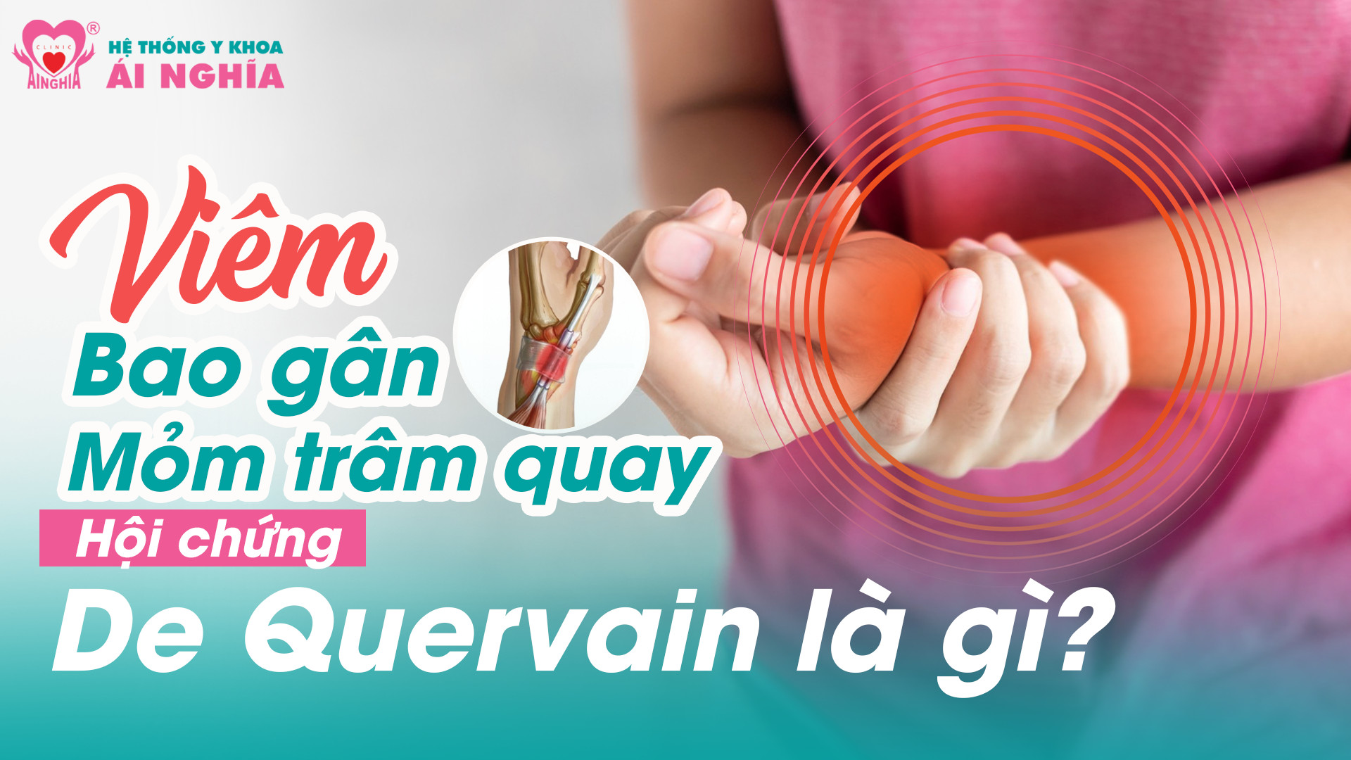 Viêm Bao gân mỏm trâm quay – Hội chứng De Quervain là gì?