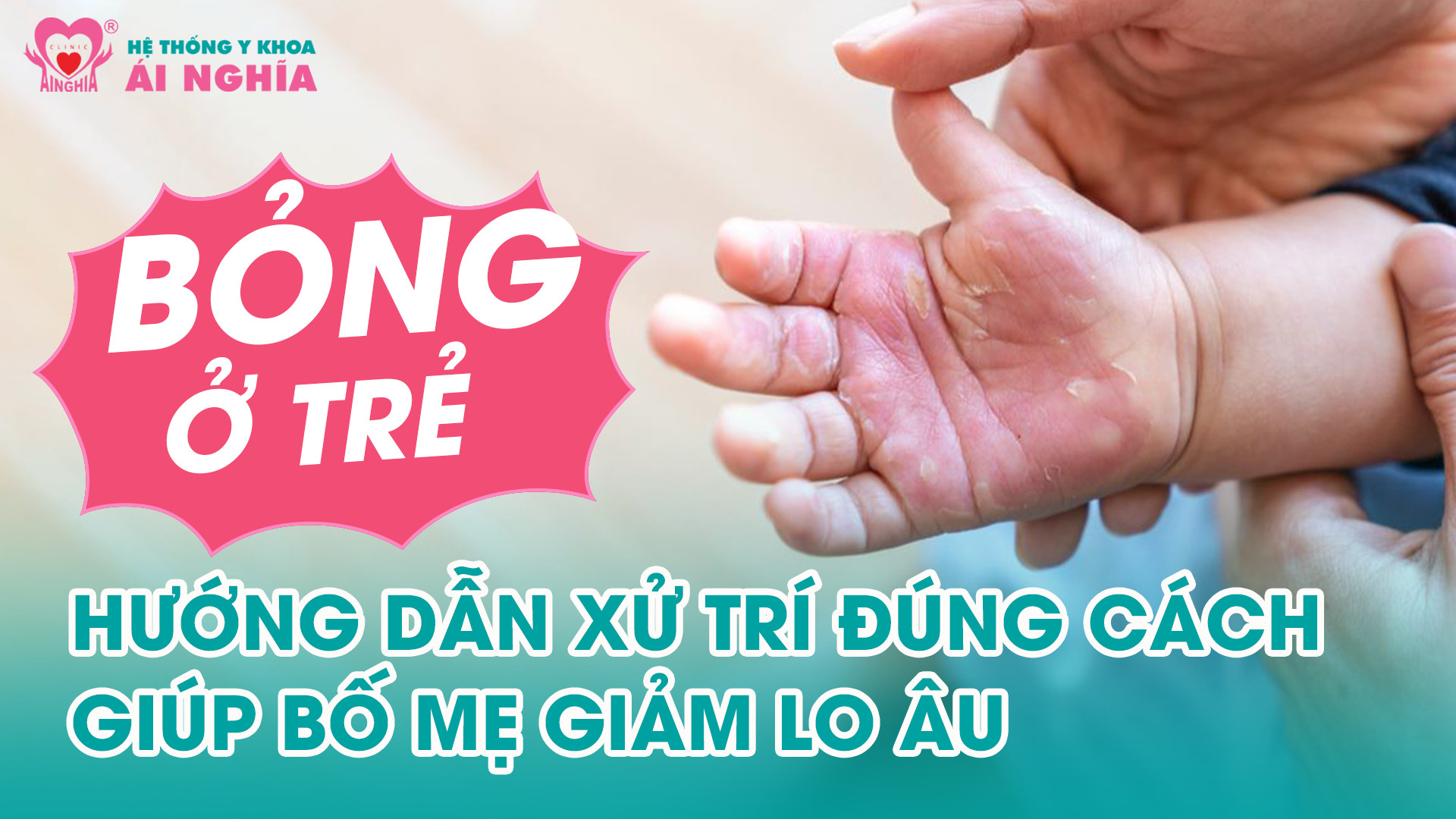 Bỏng ở trẻ nhỏ - Hướng dẫn xử trí giúp bố mẹ giảm lo âu