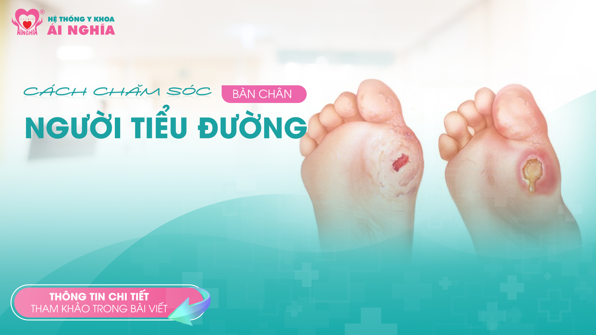 Cách chăm sóc bàn chân người tiểu đường